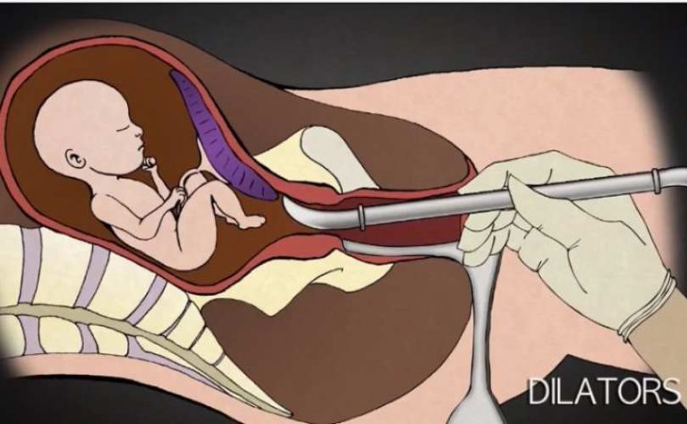 He performed 1,200 abortions. Watch animations of the procedure.